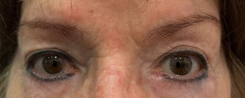blefaroplastia superior e inferior valencia