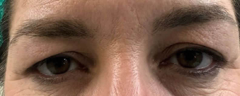 blefaroplastia superior valencia