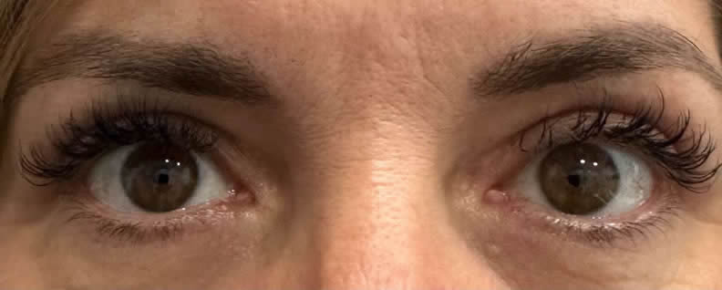 blefaroplastia superior valencia