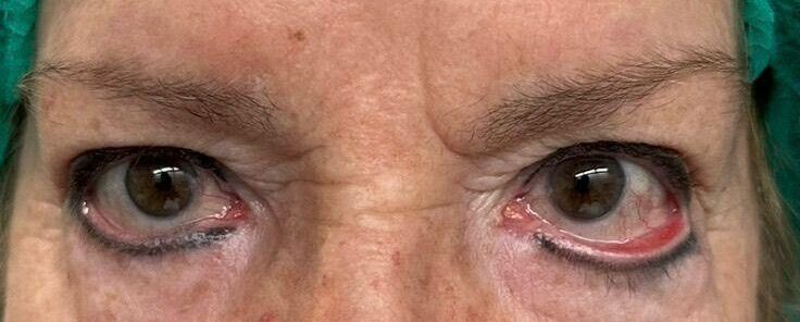 blefaroplastia superior e inferior valencia