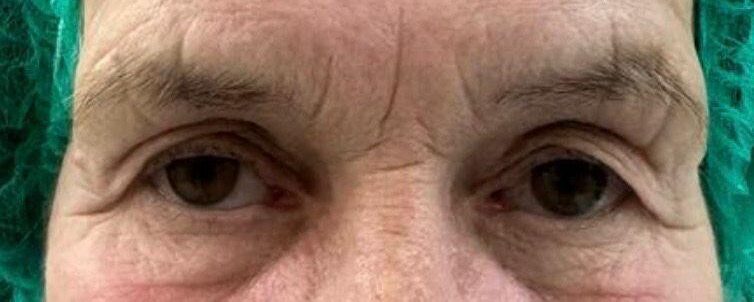 blefaroplastia valencia antes y después