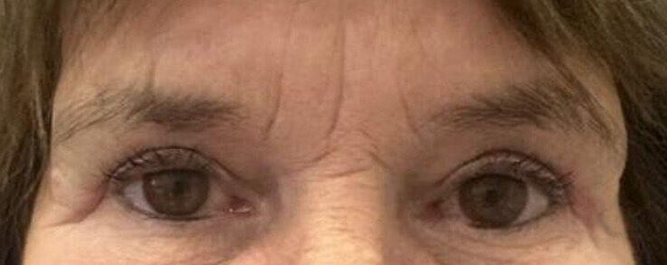 blefaroplastia valencia antes y después