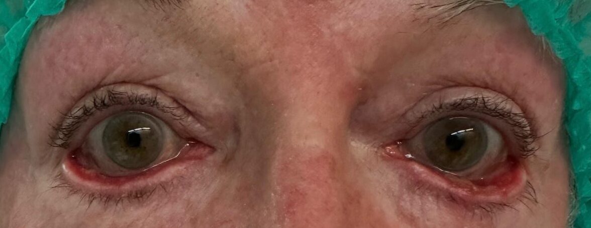 5A especialista blefaroplastia valencia