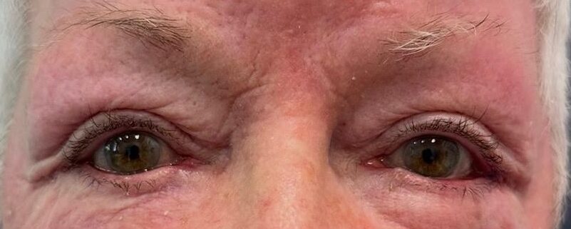 especialista blefaroplastia valencia