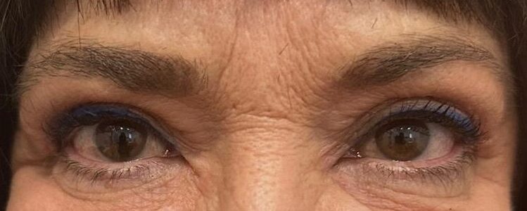 blefaroplastia en valencia