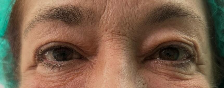 blefaroplastia en valencia